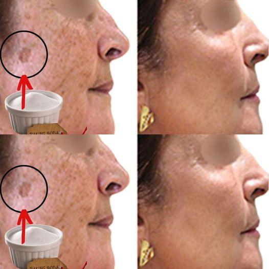 AMAZING! Baking Soda Removes Age Spots Effortlessly (Have You Tried It?)