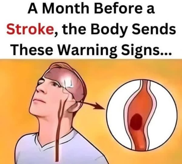 Alert: Recognize These Early Signs of a Stroke Before It's Too Late!