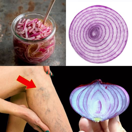 Incredible! 🤩 Red Onion: The Ultimate Varicose Vein Solution! Eliminates Varicose Veins Effortlessly!